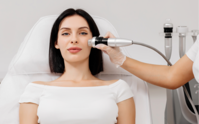 Fractional RF Microneedling
