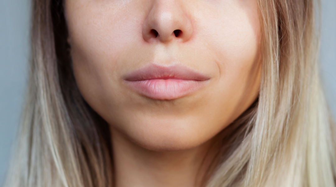 Λιπεκτομή Παρειών – Buccal Fat Removal